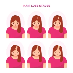 Understanding the Causes: What Type of Hair Loss Do You Have