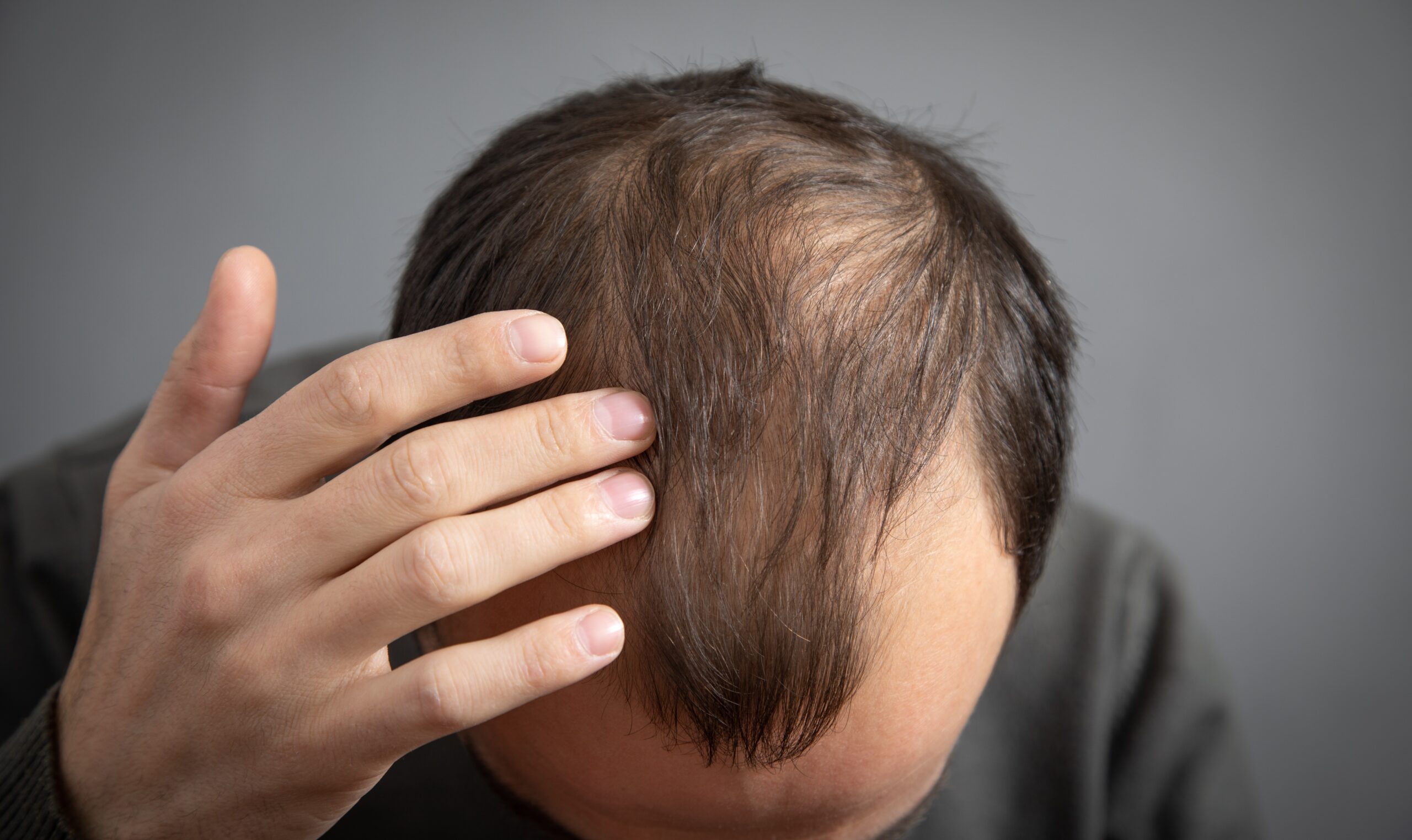 Hair loss in men